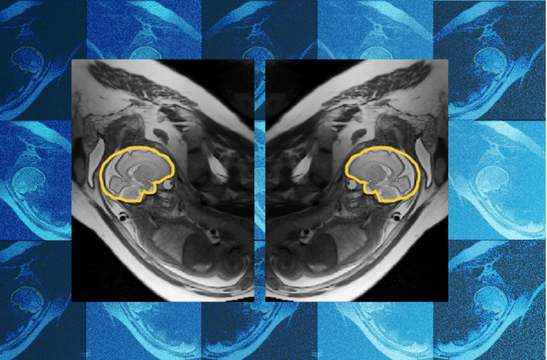 Greyscale fetal MRI showing two mirrored views of a fetus in the womb, with the fetal brain outlined in yellow in each image. A tiled blue background pattern o…